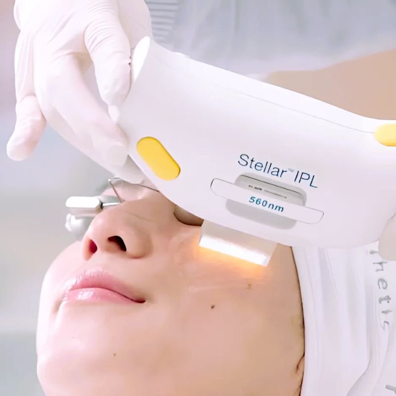 Tratamente cu Lumenis Stellar M22 la clinica Age Control din Chișinău