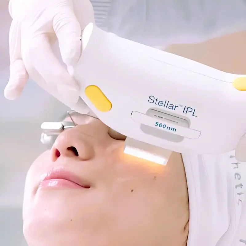 Tratamente Lumenis Stellar M22 Chișinău